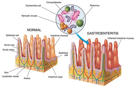 Overview of Gastroenteritis .